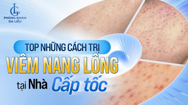 cách trị viêm nang lông tại nhà