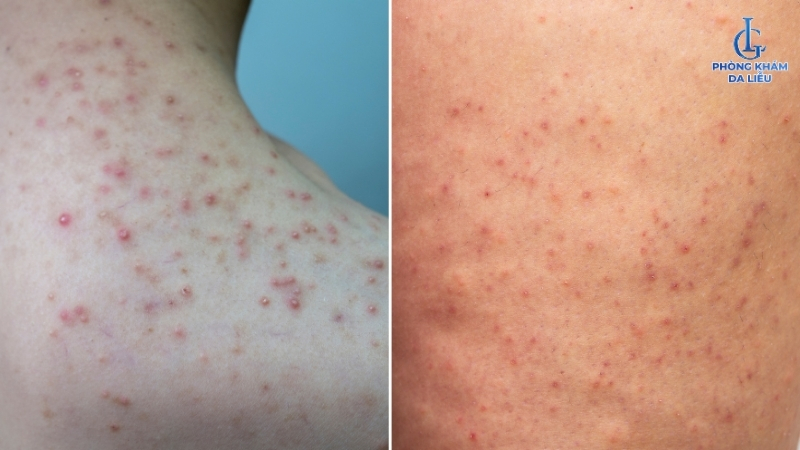 chi phí điều trị viêm nang lông theo vị trí