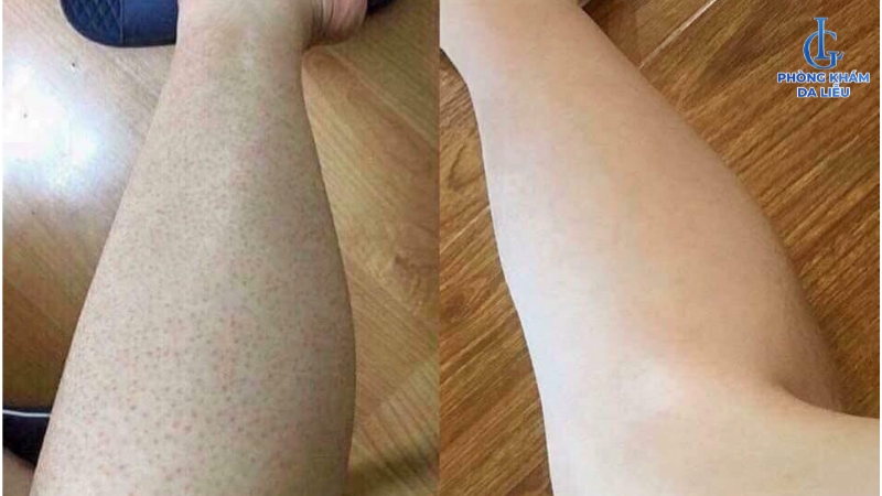 cách trị viêm nang lông