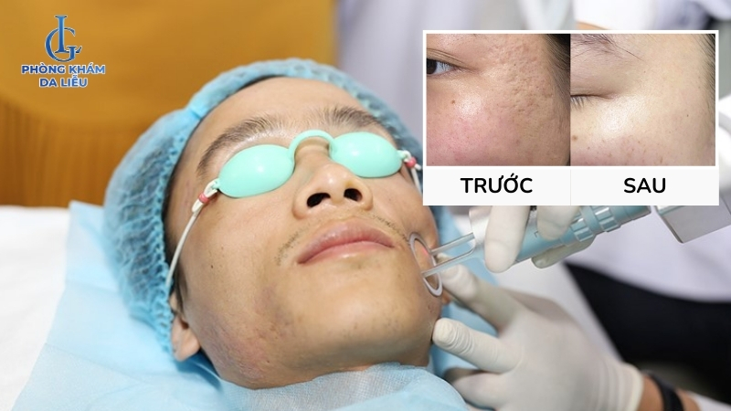 Trị sẹo rỗ chuyên sâu