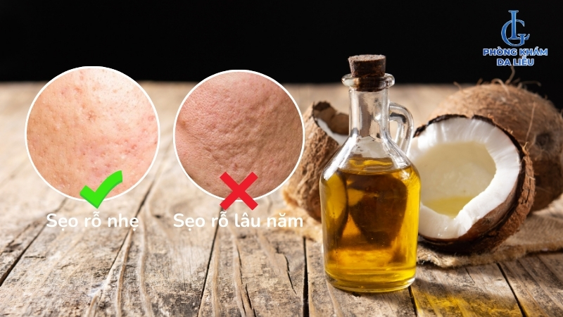 Dầu dừa trị sẹo rỗ nhẹ