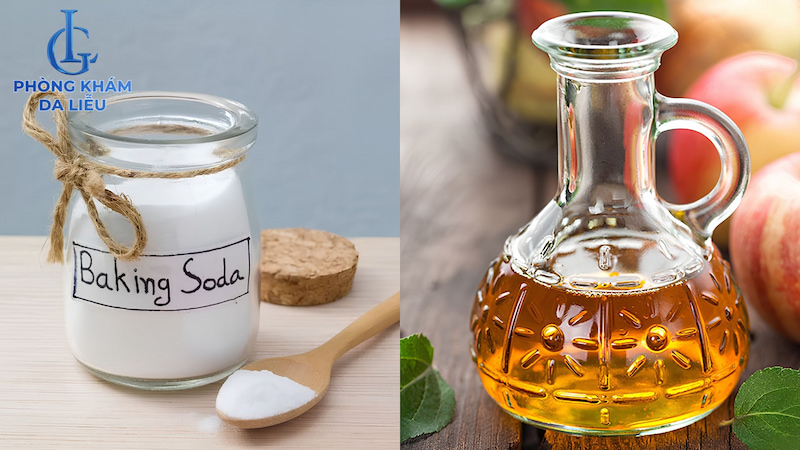 điều trị mụn lưng bằng giấm táo và baking soda