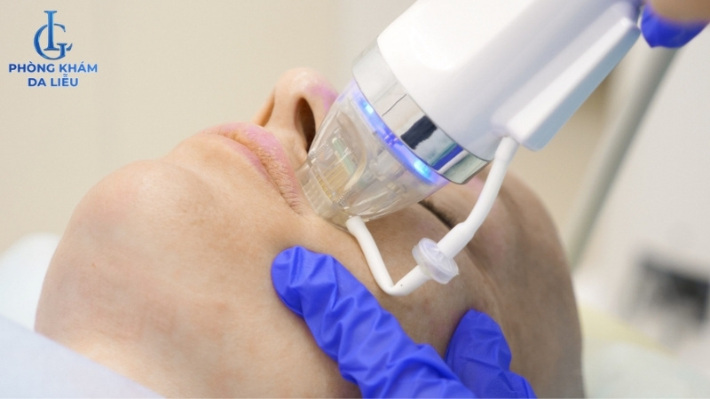 điều trị sẹo rỗ bằng rf needle vi kim