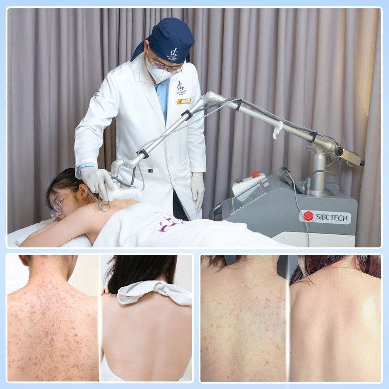 điều trị viêm lỗ chân lông bằng laser