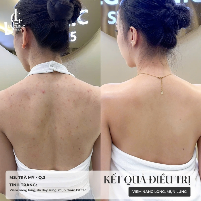 điều trị viêm nang lông lưng