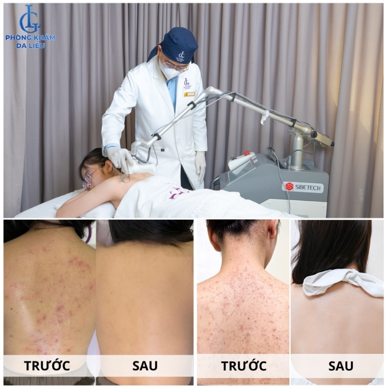 điều trị viêm nang lông tại phòng khám da liễu lg