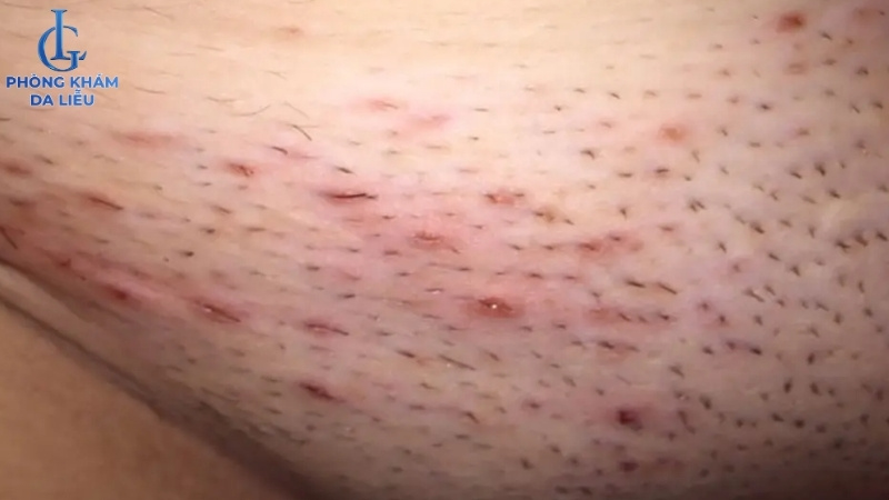 hình ảnh bị viêm nang lông vùng kín