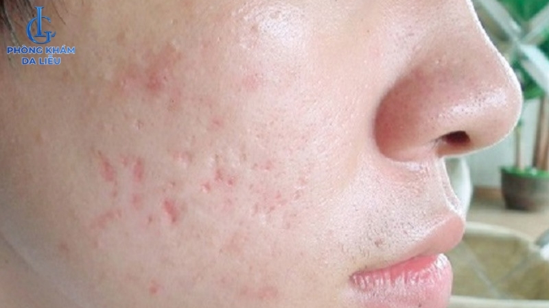 hình ảnh sẹo lõm trên mặt