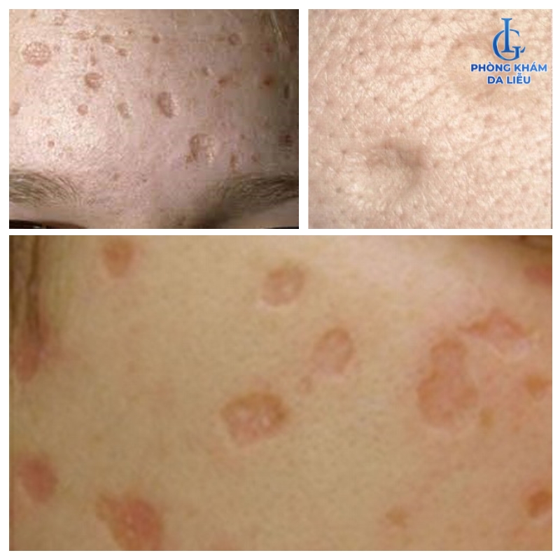 sẹo lõm hình thành