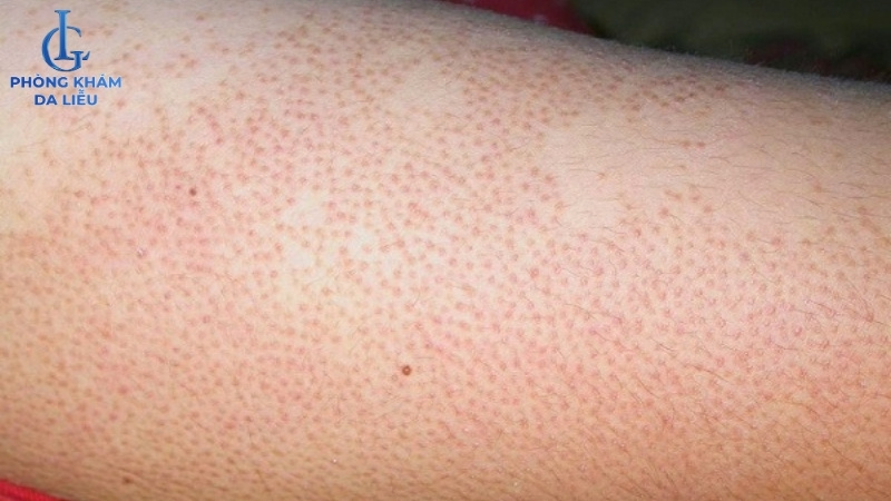 hình ảnh viêm nang lông ở chân