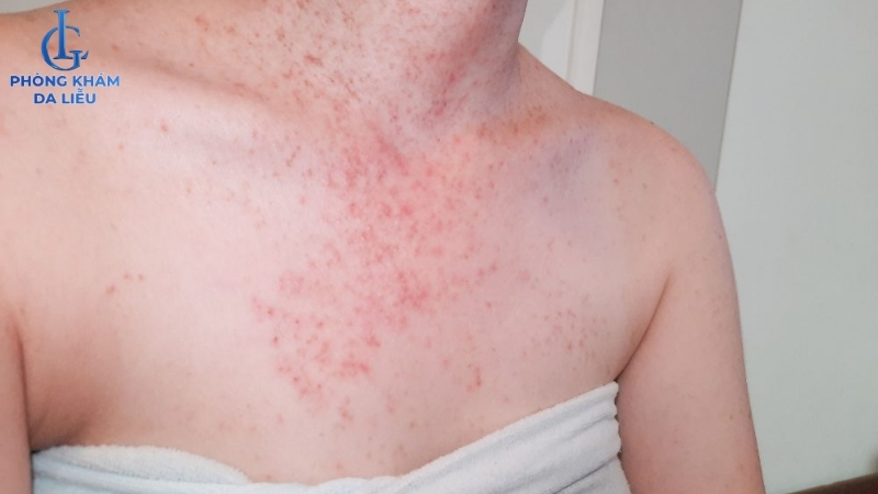 hình ảnh viêm nang lông ở ngực