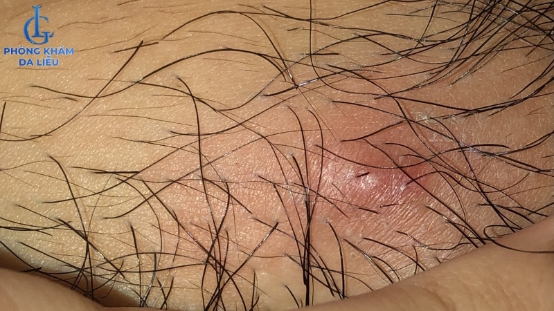 hình ảnh viêm nang lông vùng kín