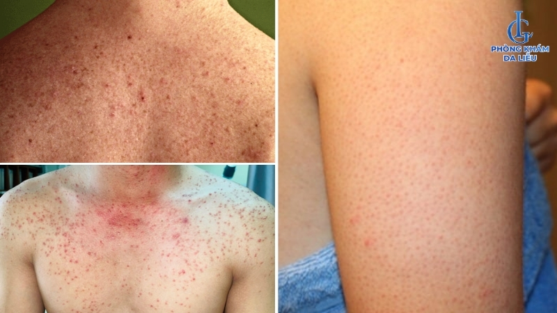 hình ảnh viêm nang lông