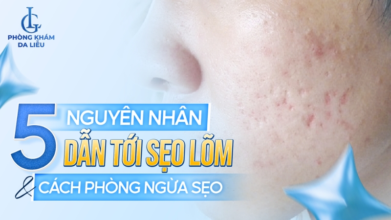 nguyên nhân dẫn tới sẹo lõm