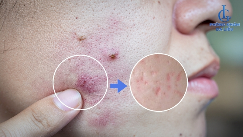 nguyên nhân sẹo lõm