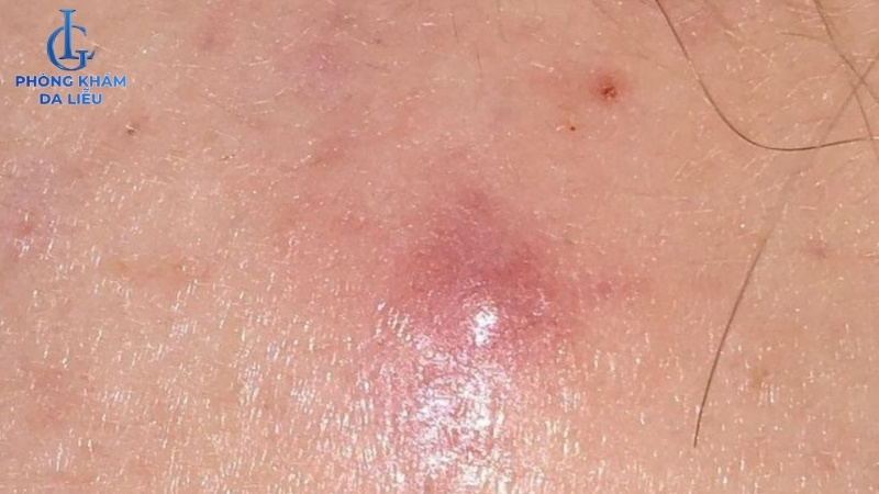 nổi mụn nhọt do viêm nang lông vùng kín