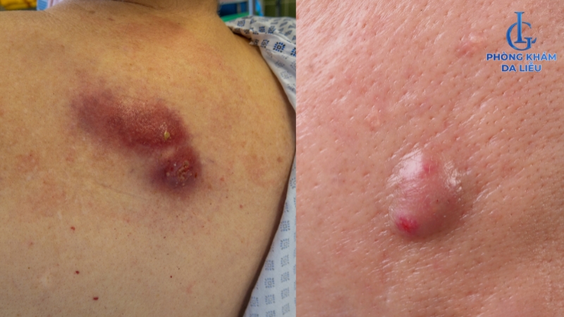 ổ viêm để lại sẹo lõm