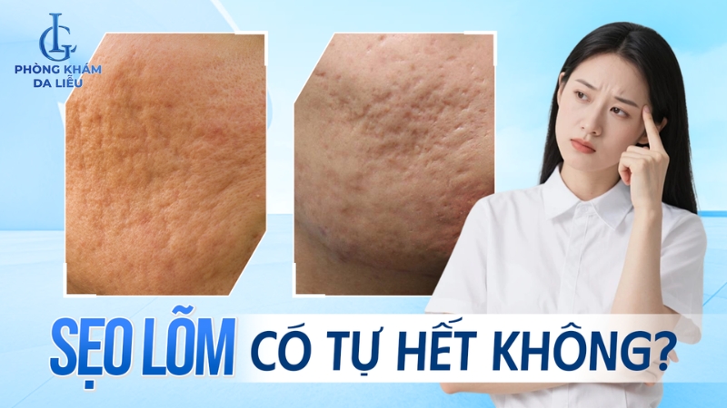 sẹo lõm có tự hết không