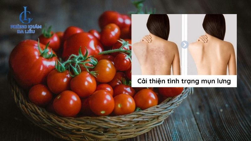 trị mụn lưng bằng cà chua tại nhà