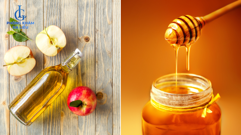 giấm táo và mật ong trị mụn lưng