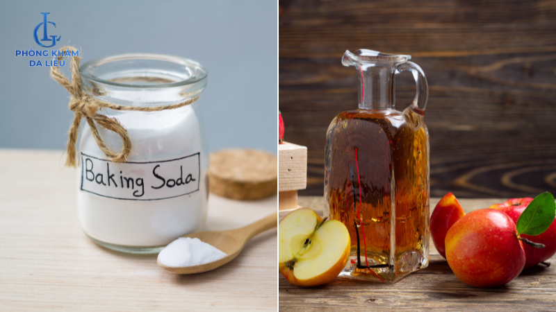 giấm táo và baking soda trị mụn lưng