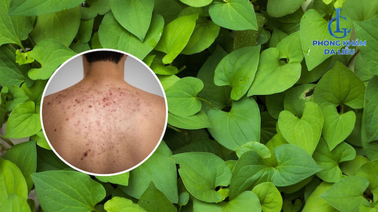 Cách điều trị mụn lưng hiệu quả giúp sạch mụn nhanh chóng