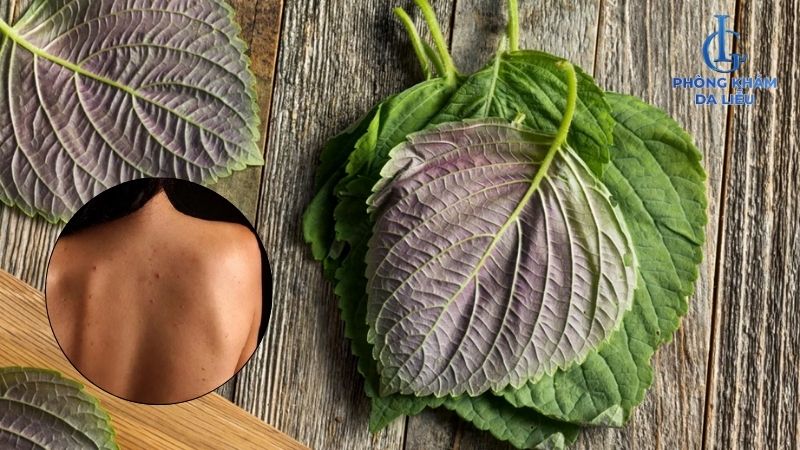 trị mụn lưng bằng lá tía tô