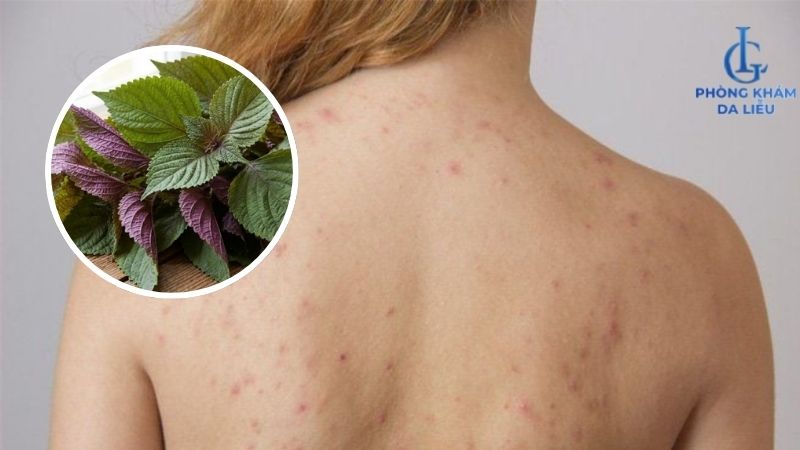 trị mụn lưng bằng lá tía tô