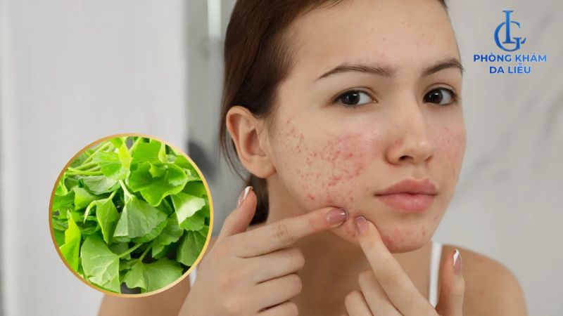 rau má ngừa mụn
