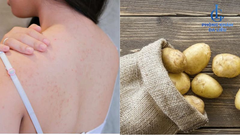 khoai tây trị mụn