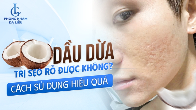 trị sẹo rỗ bằng dầu dừa