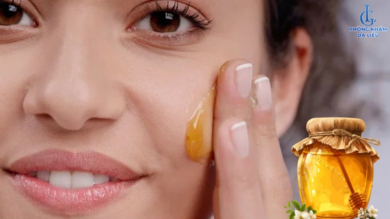 Trị sẹo rỗ bằng mật ong