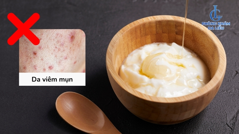 Không đắp sữa chua khi mụn viêm