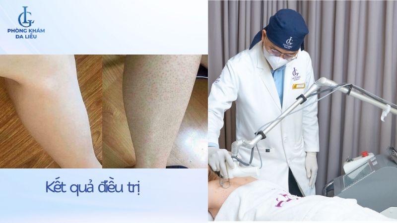 cách trị viêm lỗ chân lông ở bắp chân