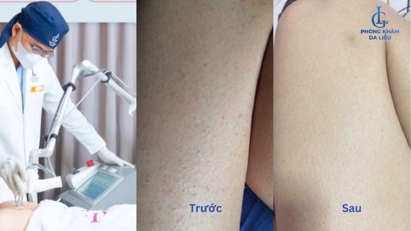 trị viêm nang lông ở đùi