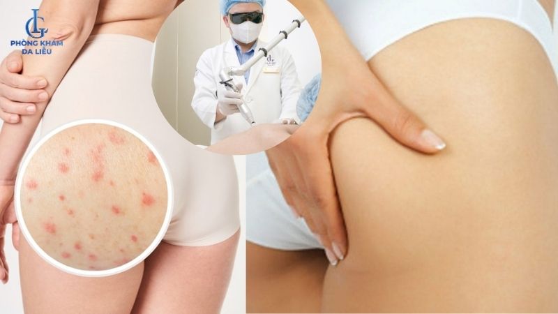 trị viêm nang lông ở mông