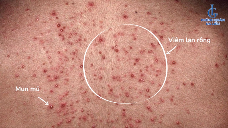 trị bệnh viêm nang lông