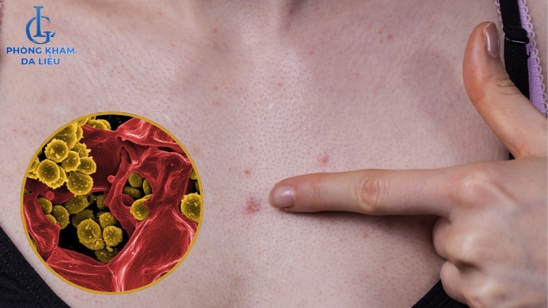 tụ cầu vàng là nguyên nhân chính gây viêm nang lông