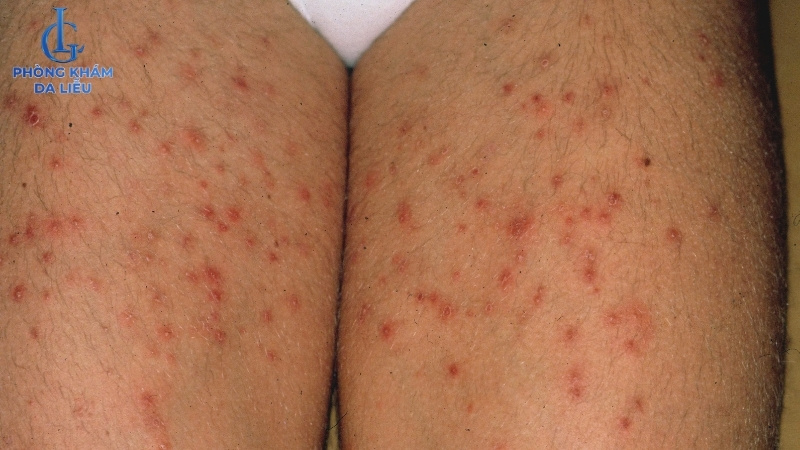 viêm lỗ chân lông ở chân