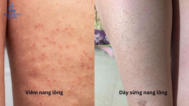viêm nang lông đùi và dày sừng nang lông