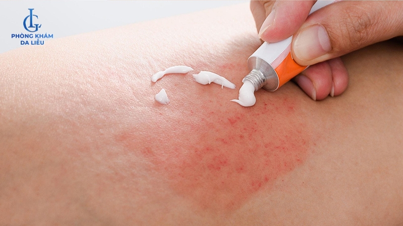 chữa viêm lỗ chân lông ở tay