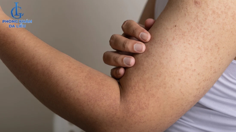 viêm lỗ chân lông ở tay