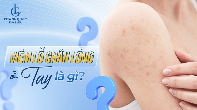viêm lỗ chân lông ở tay