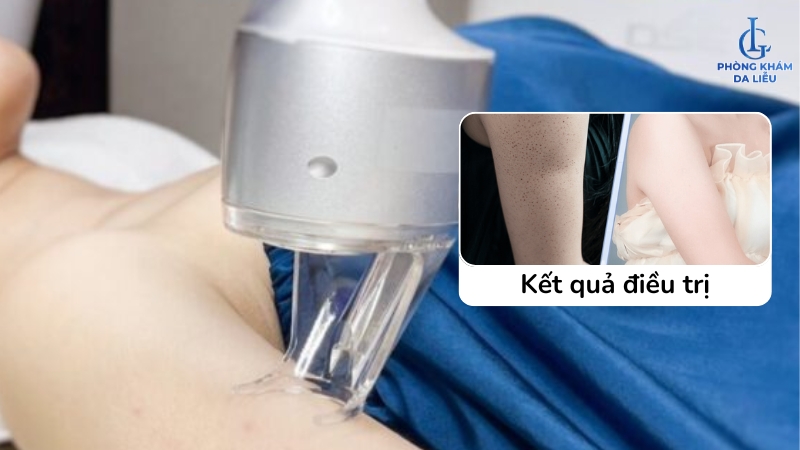 điều trị viêm lỗ chân lông ở bắp tay