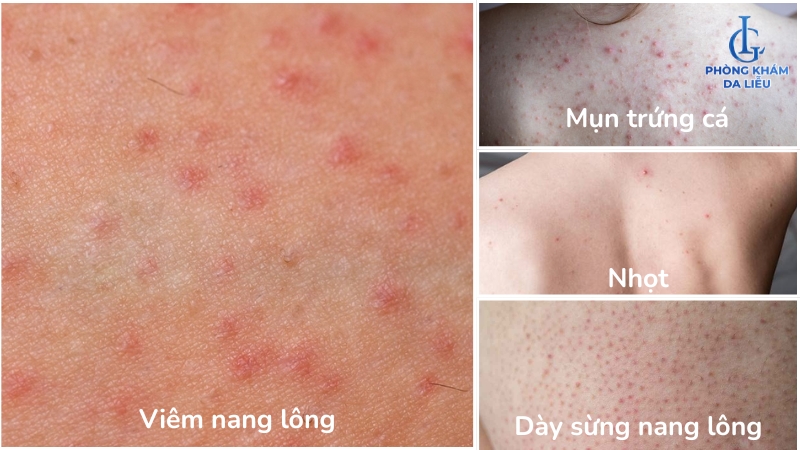 viêm lỗ chân lông