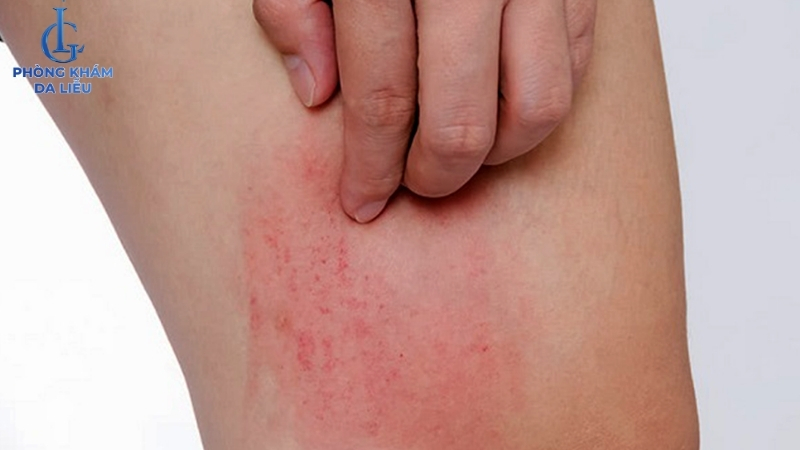 viêm nang lông chân gây ngứa ngáy