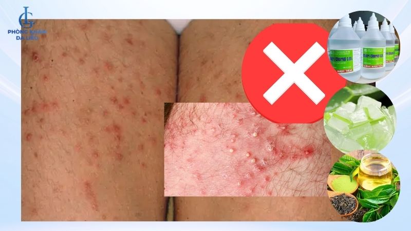 viêm lỗ chân lông ở đùi