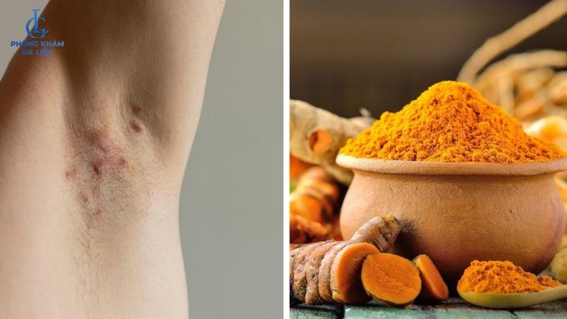 viêm lỗ chân lông nách