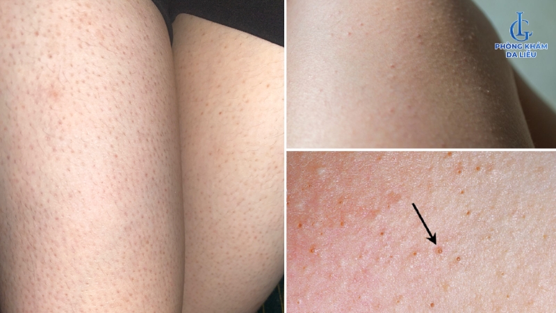 viêm nang lông ở chân