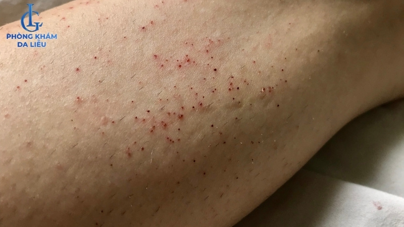 viêm nang lông ở chân nổi nốt đỏ